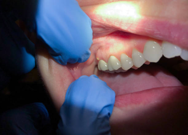 Best Emergency Denture Repair in Allentown, NJ