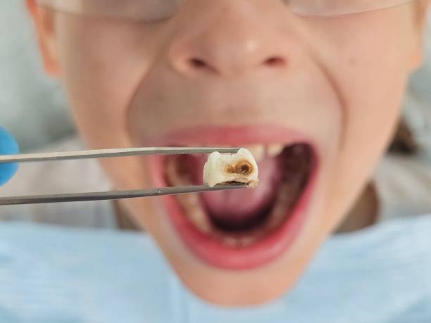 Best Emergency Gum Treatment in Allentown, NJ